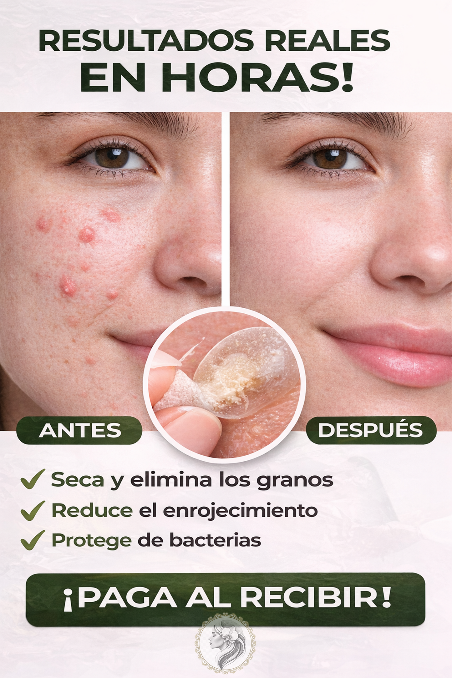 STIKER PARA EL ACNE